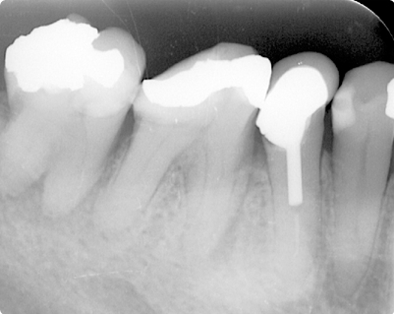Endodontic Case 1 - Before