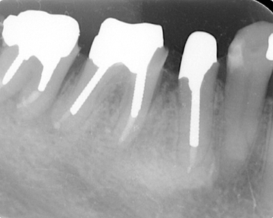 Endodontic Case 1 - After