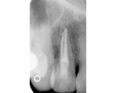 Endodontic Case 2 - After