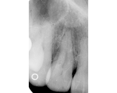 Endodontic Case 2 - Before