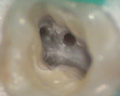 Endodontic Case 3 - Before