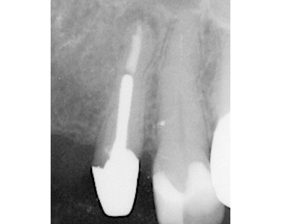 Endodontic Case 4 - After