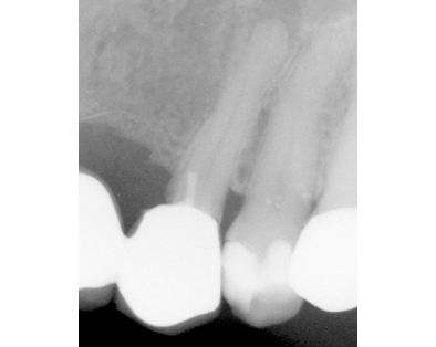 Endodontic Case 4 - Before