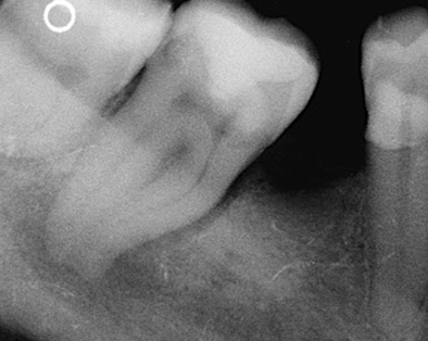Endodontic Case 5 - Before