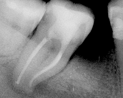 Endodontic Case 5 - After