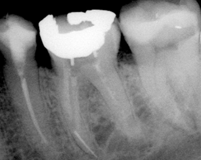 Endodontic Case 6 - Before