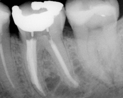 Endodontic Case 6 - After